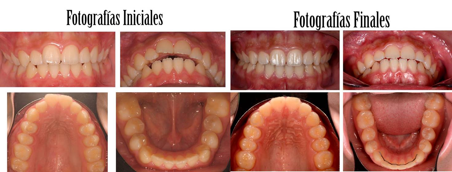 Ortodoncia: tratamientos en 14 meses